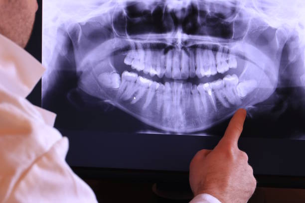 Best Emergency Dental Care for Abscessed Tooth in Coupeville, WA