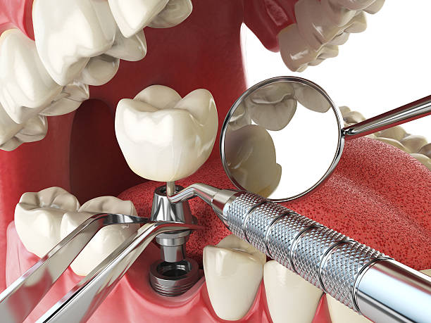 Best Broken or Cracked Tooth Emergency Dentist in Coupeville, WA